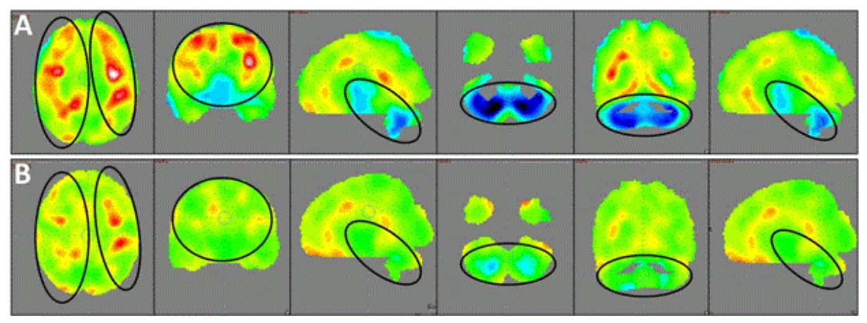 患者の脳のPET-CTスキャンの画像
